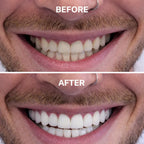 Purple Teeth Whitening Strips – PAP Formula