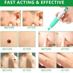Skin Tag & Mole Remover Kit – 2-in-1 Tool