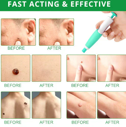 QunatroBay™ 2-in-1 Painless Skin Tag, Mole, and Wart Removal Kit