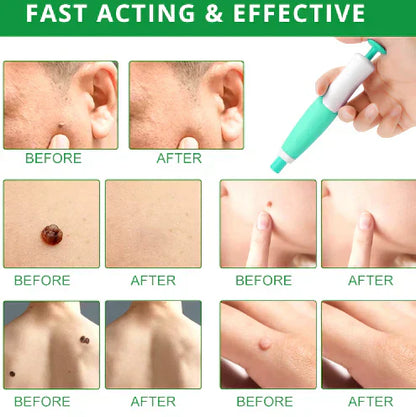 QunatroBay™ 2-in-1 Painless Skin Tag, Mole, and Wart Removal Kit