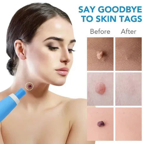QunatroBay™ 2-in-1 Painless Skin Tag, Mole, and Wart Removal Kit